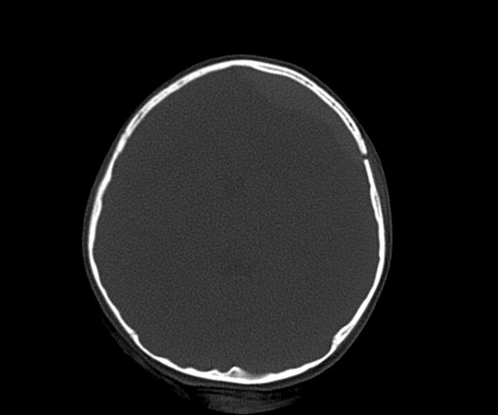 File:Acute epidural hematoma (Radiopaedia 63659-72335 Axial bone window 16).jpg
