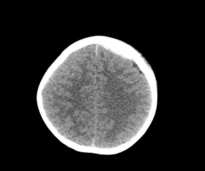 File:Acute epidural hematoma (Radiopaedia 63659-72335 Axial non-contrast 18).jpg