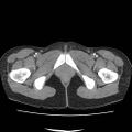 Acute myocarditis (Radiopaedia 55988-62613 Axial C+ portal venous phase 85).jpg