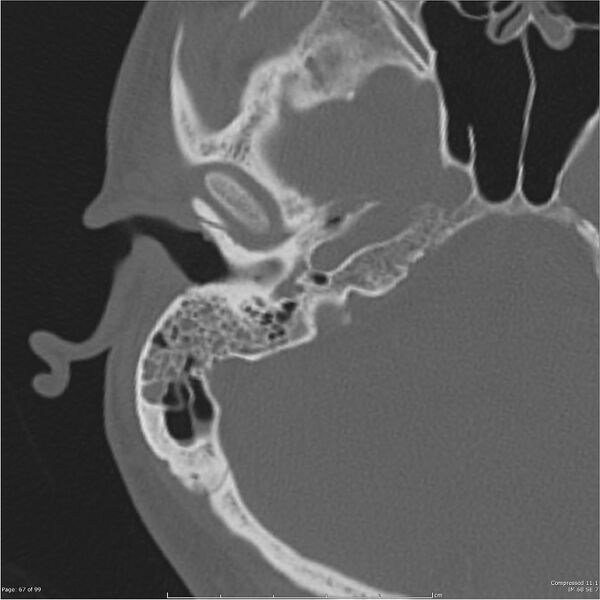 File:Acute otomastoiditis (Radiopaedia 28276-28512 Axial PTB bone window reformat 47).jpg