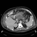 Acute pancreatic necrosis (Radiopaedia 13560-18503 Axial C+ portal venous phase 22).jpg