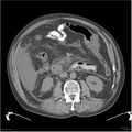 Acute pancreatitis (Radiopaedia 19135-19116 Axial non-contrast 24).jpg