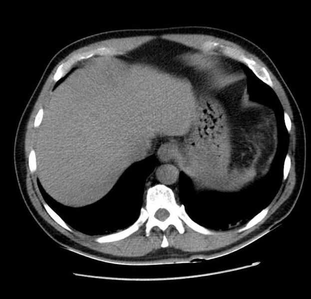 File:Acute pancreatitis - Balthazar E (Radiopaedia 23080-23110 Axial non-contrast 10).jpg