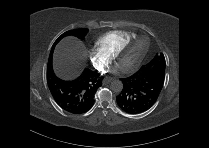 Acute pulmonary embolism (Radiopaedia 29938-30466 Axial C+ CTPA 156).jpg