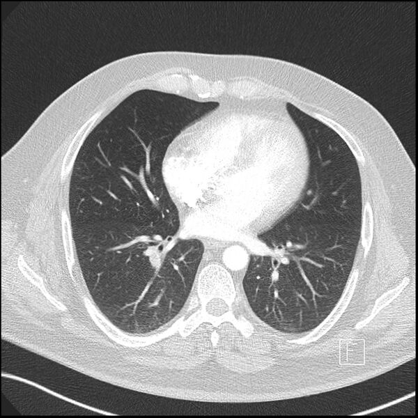 File:Acute pulmonary embolism with pulmonary infarct (Radiopaedia 73062-83768 Axial lung window 1).jpg