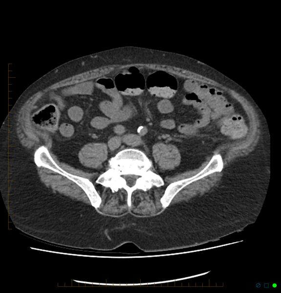 File:Acute renal failure post IV contrast injection- CT findings (Radiopaedia 47815-52557 Axial non-contrast 55).jpg