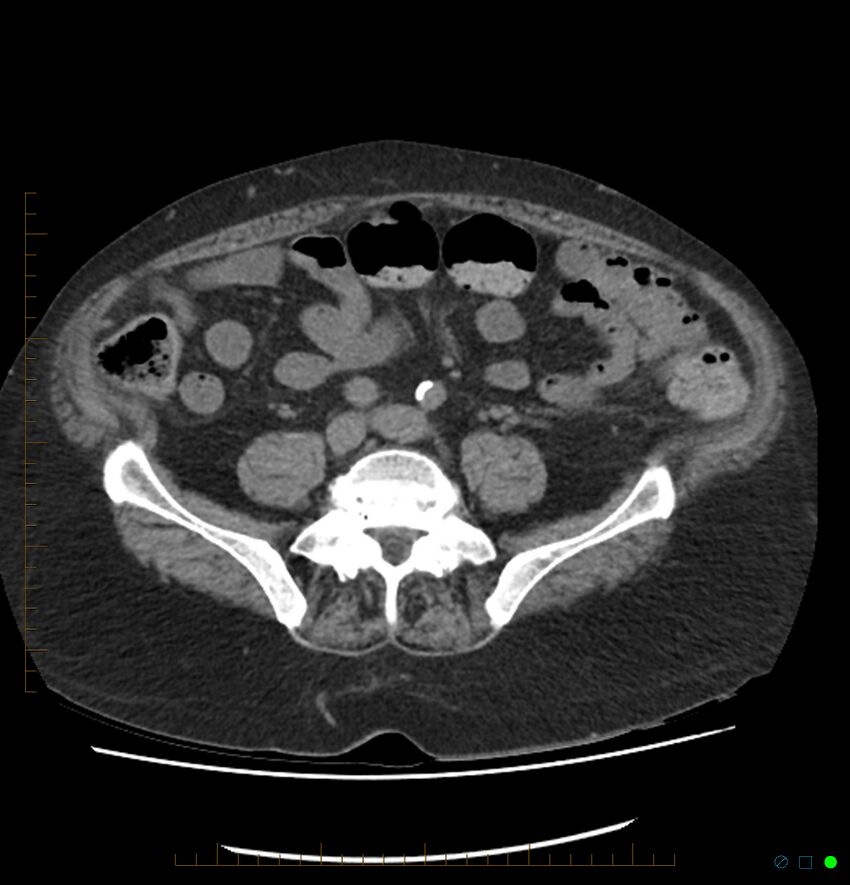 Acute renal failure post IV contrast injection- CT findings (Radiopaedia 47815-52557 Axial non-contrast 55).jpg