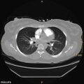 Acute reversible pulmonary hypertension and right heart failure from cocaine toxicity (Radiopaedia 49394-54517 Axial C+ CTPA 5).jpg