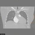 Acute reversible pulmonary hypertension and right heart failure from cocaine toxicity (Radiopaedia 49394-54517 Coronal C+ CTPA 15).jpg