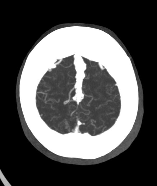 File:Acute right MCA M1 occlusion (Radiopaedia 62268-70454 Axial Phase 2 5).jpg