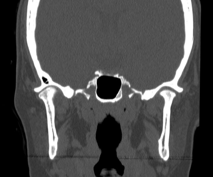 File:Acute sinusitis (Radiopaedia 22419-22455 Coronal bone window 38).jpg