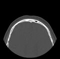 Acute sinusitis (Radiopaedia 23161-23215 Axial bone window 81).jpg