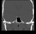 Acute sinusitis (Radiopaedia 23161-23215 Coronal bone window 55).jpg
