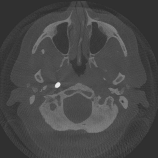File:Acute subarachnoid hemorrhage and accessory anterior cerebral artery (Radiopaedia 69231-79010 Axial arterial - MIP 5).jpg