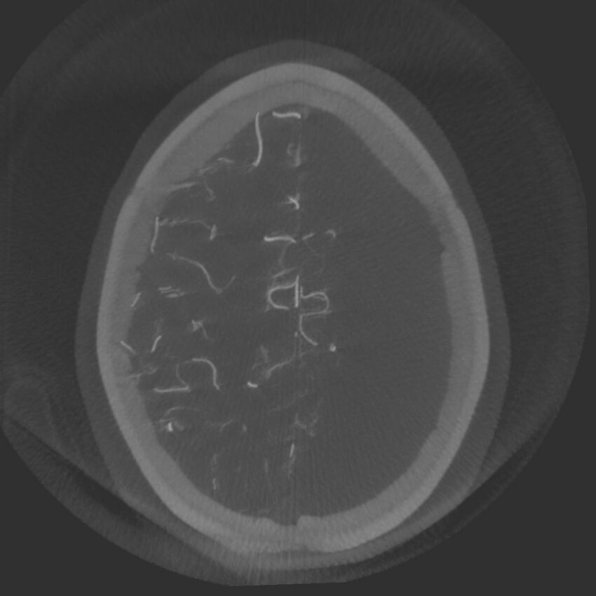 Acute subarachnoid hemorrhage and accessory anterior cerebral artery (Radiopaedia 69231-79010 Axial arterial - MIP 68).jpg