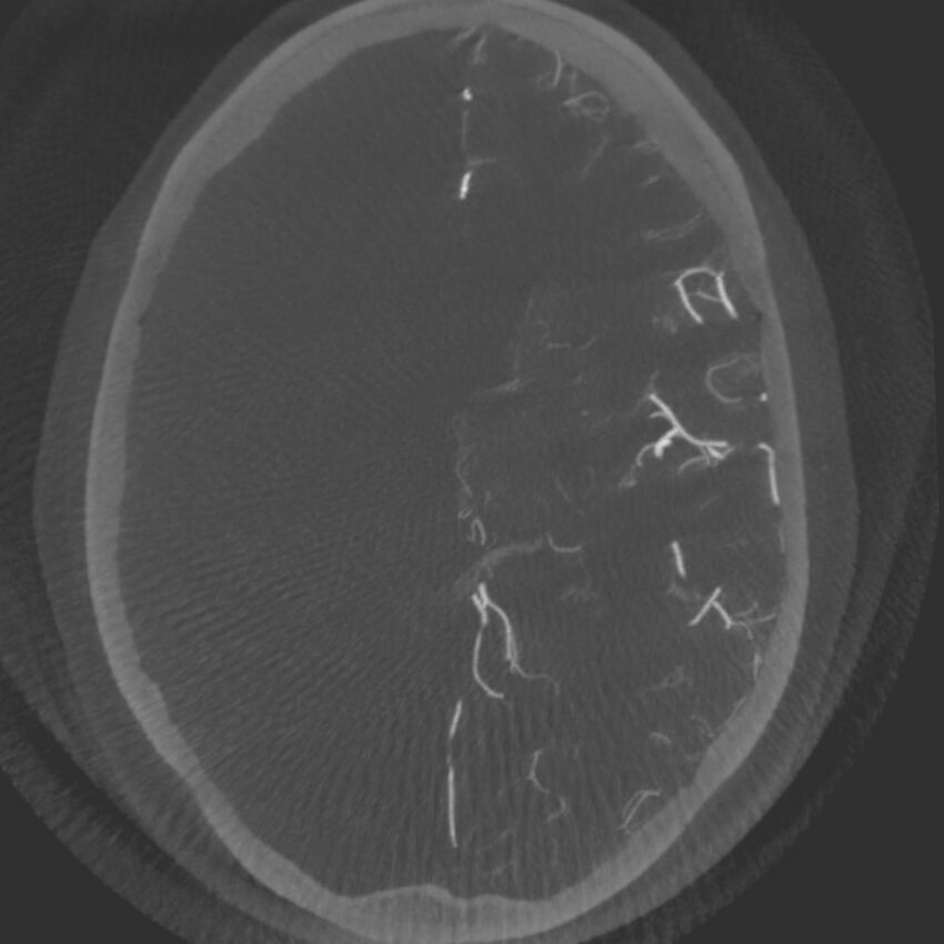 Acute subarachnoid hemorrhage and accessory anterior cerebral artery (Radiopaedia 69231-79010 C 41).jpg