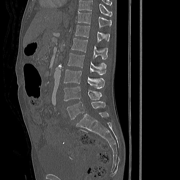File:Acute vertebral body compression fractures (Radiopaedia 31757-32693 Sagittal bone window 26).jpg