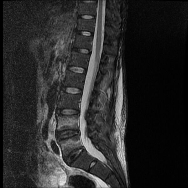 File:Acute vertebral body compression fractures (Radiopaedia 31757-32694 Sagittal STIR 8).jpg