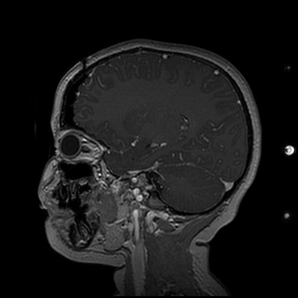 File:Adamantinomatous craniopharyngioma (Radiopaedia 77407-89529 H 43).jpg