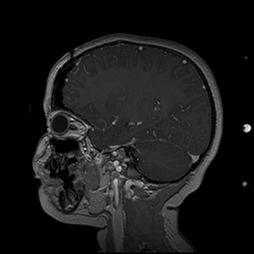 Adamantinomatous craniopharyngioma (Radiopaedia 77407-89529 H 43).jpg