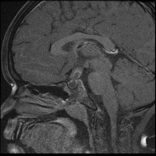 File:Adamantinomatous craniopharyngioma (Radiopaedia 77407-89529 Sagittal T1 C+ fat sat 8).jpg
