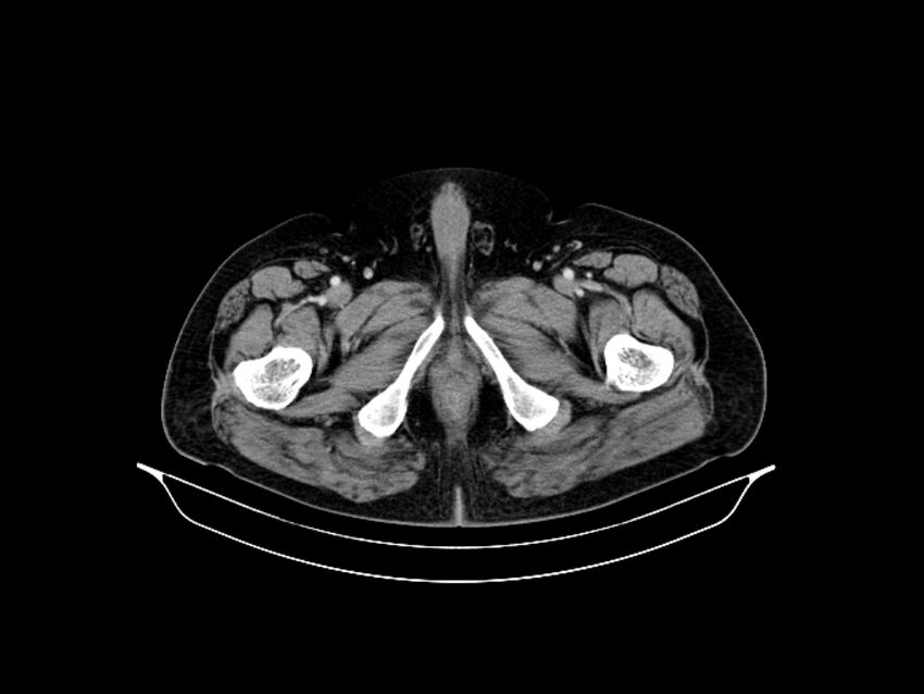 Adenocarcinoma of pancreas with hepatic metastasis (Radiopaedia 64332-73122 Axial C+ portal venous phase 105).jpg
