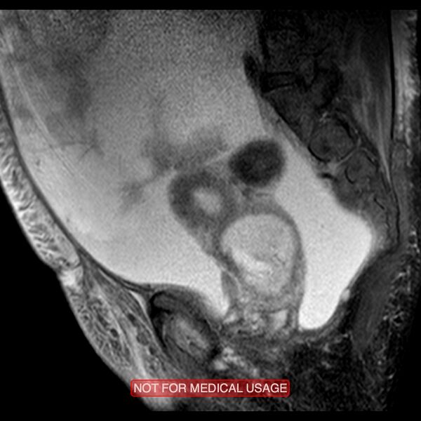File:Adenocarcinoma of the cervix (Radiopaedia 28373-28615 Sagittal T2 fat sat 12).jpg