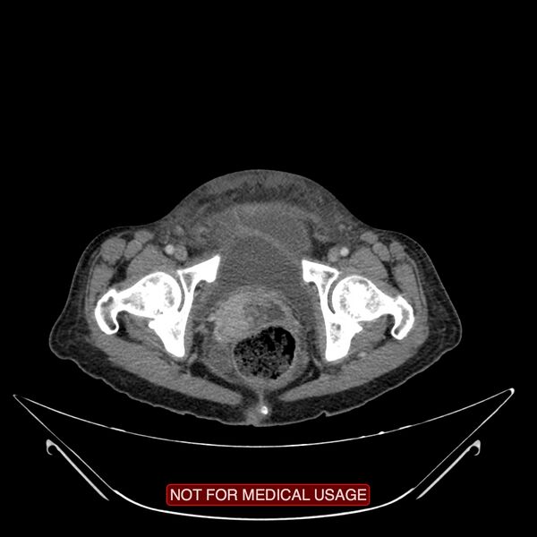 File:Adenocarcinoma of the cervix (Radiopaedia 28373-28616 Axial C+ portal venous phase 24).jpg