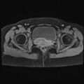 Adenomyosis and endometriotic cysts (Radiopaedia 82300-96367 Axial T1 C+ fat sat 6).jpg