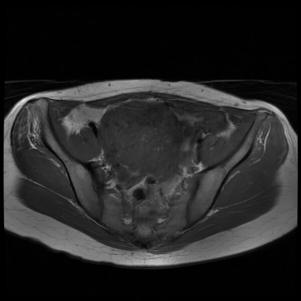 File:Adenomyosis on MRI (Radiopaedia 29328-29780 Axial T1 2).jpg