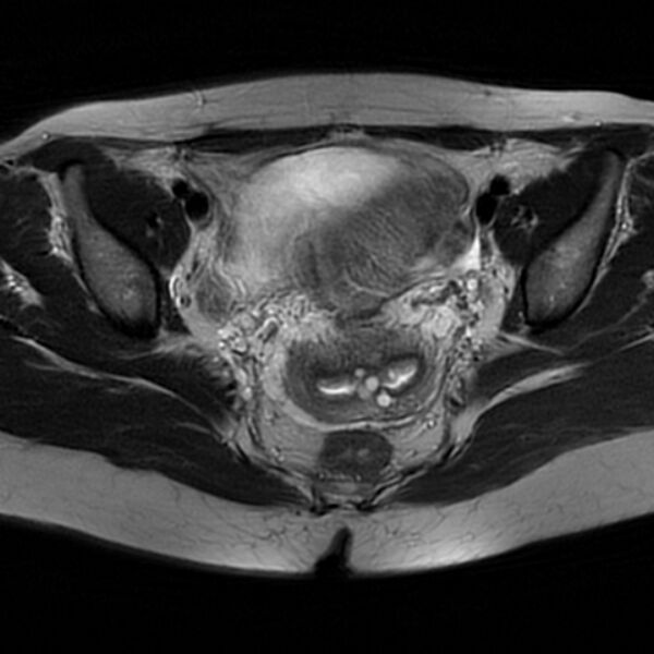 File:Adenomyosis within a septate uterus (Radiopaedia 69963-79981 Axial T2 20).jpg