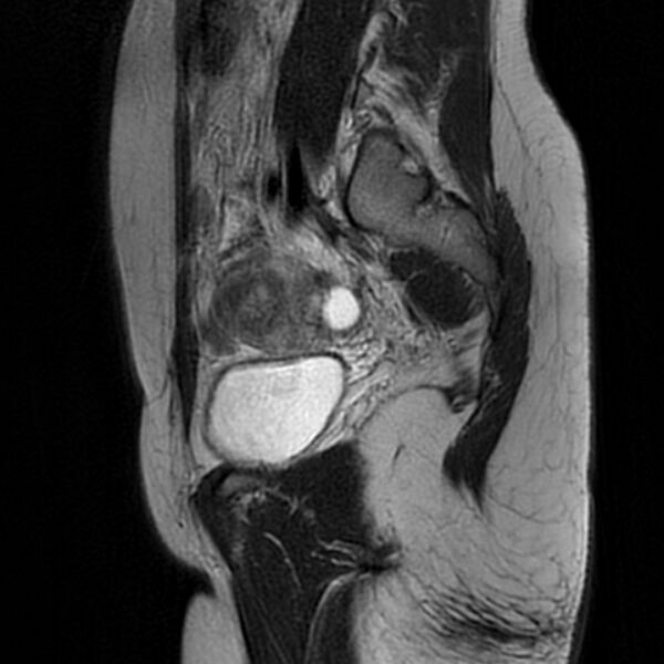 File:Adenomyosis within a septate uterus (Radiopaedia 69963-79981 Sagittal T2 9).jpg