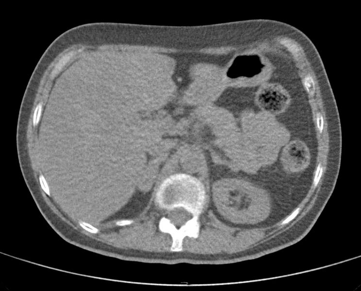 File:Adenosquamous lung carcinoma (Radiopaedia 22035-22030 non-contrast 61).jpg