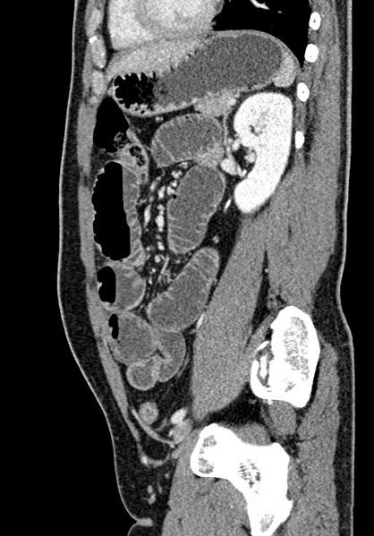File:Adhesional small bowel obstruction (Radiopaedia 58900-66131 Sagittal C+ portal venous phase 166).jpg