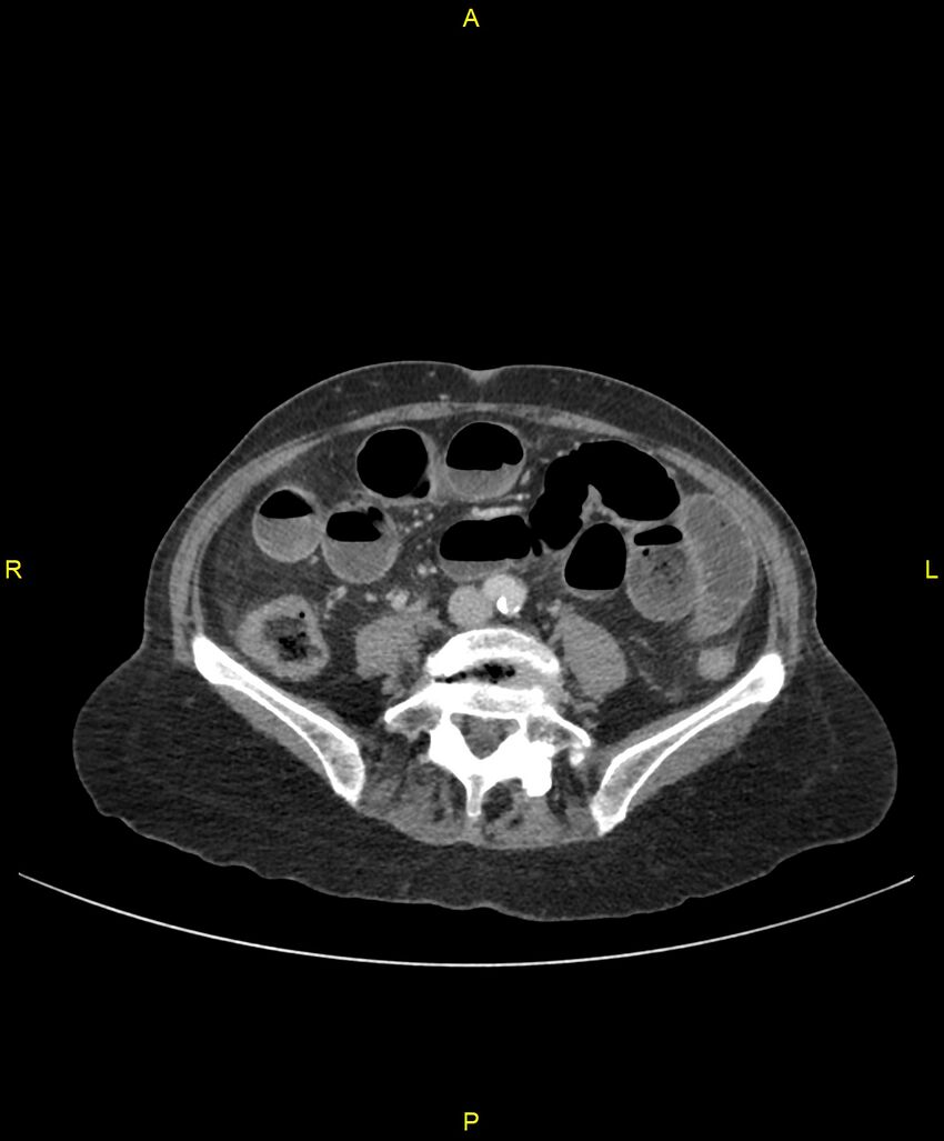 Adhesional small bowel obstruction (Radiopaedia 85402-101024 Axial C+ portal venous phase 176).jpg