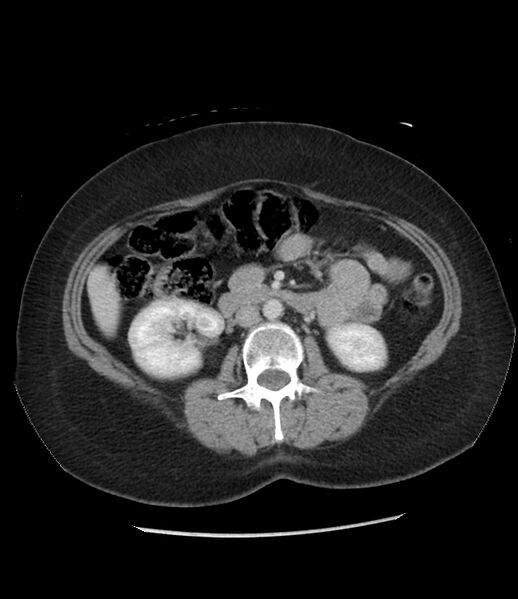 File:Adrenal cortical carcinoma with IVC invasion and thrombosis (Radiopaedia 34307-35597 Axial C+ portal venous phase 42).jpg