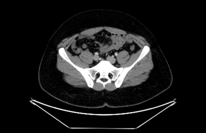 File:Adrenocortical carcinoma (Radiopaedia 80134-93438 Axial C+ portal venous phase 98).jpg