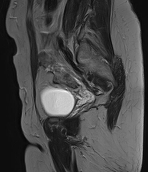 File:Adult granulosa cell tumor of the ovary (Radiopaedia 71581-81950 Sagittal T2 17).jpg