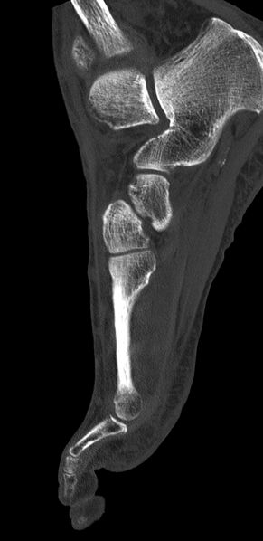 File:Advanced osteomyelitis due to open metatarsal fracture (Radiopaedia 83891-99095 C 13).jpg