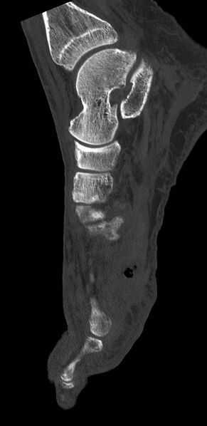 File:Advanced osteomyelitis due to open metatarsal fracture (Radiopaedia 83891-99095 C 9).jpg