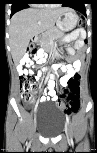 File:Agenesis of the gallbladder (Radiopaedia 55454-61905 A 17).jpg