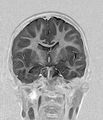 Aicardi syndrome (Radiopaedia 66029-75205 Coronal T1-IR 12).jpg