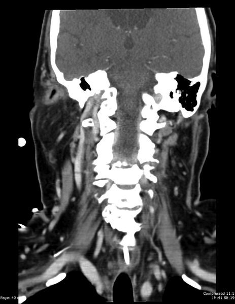 File:Airway narrowing post surgical drainage of neck abscess (Radiopaedia 28885-29206 B 31).jpg