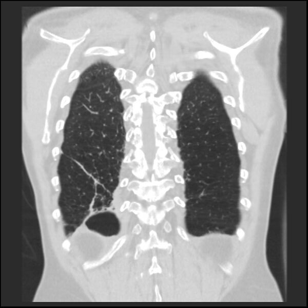 File:Alpha-1-antitrypsin deficiency (Radiopaedia 40993-43722 Coronal lung window 90).jpg