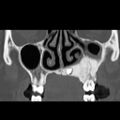 Ameloblastic fibro-odontoma (Radiopaedia 18843-18780 B 13).jpg