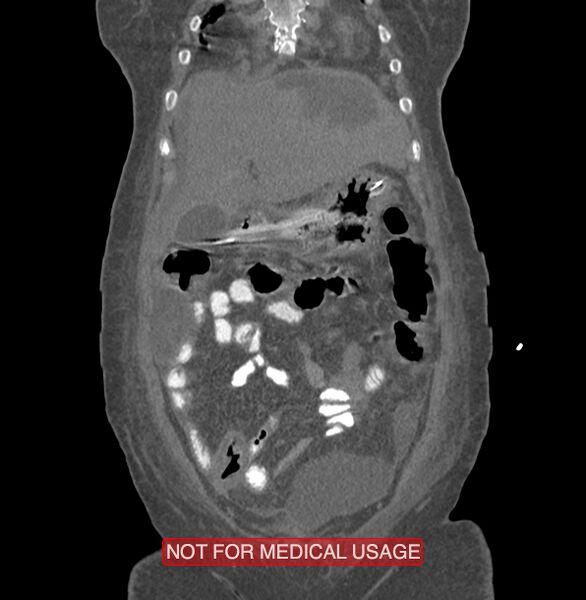 File:Amoebic enterocolitis with liver abscess (Radiopaedia 35100-36609 B 30).jpg