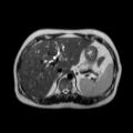 Ampullary tumor (Radiopaedia 27294-27479 T2 22).jpg