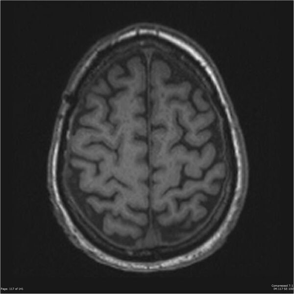 File:Anaplastic meningioma with recurrence (Radiopaedia 34452-35788 Axial T1 115).jpg