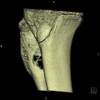 CT scan: ABC fibula
