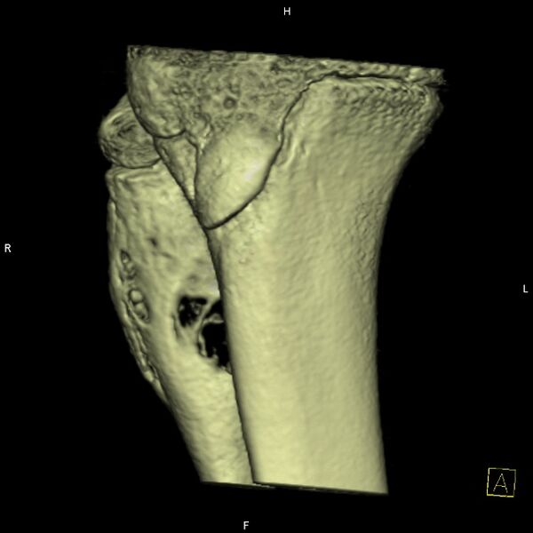 File:Aneurysmal bone cyst (ABC) (Radiopaedia 14333-14240 bone window 12).jpg